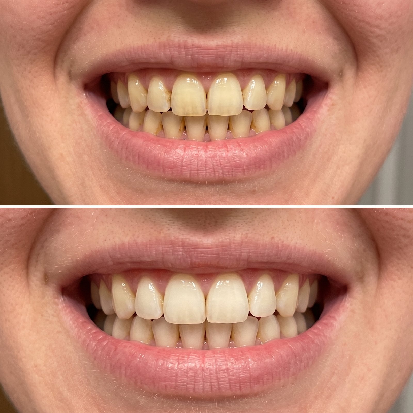 Coffee staining, before and after surface whitening