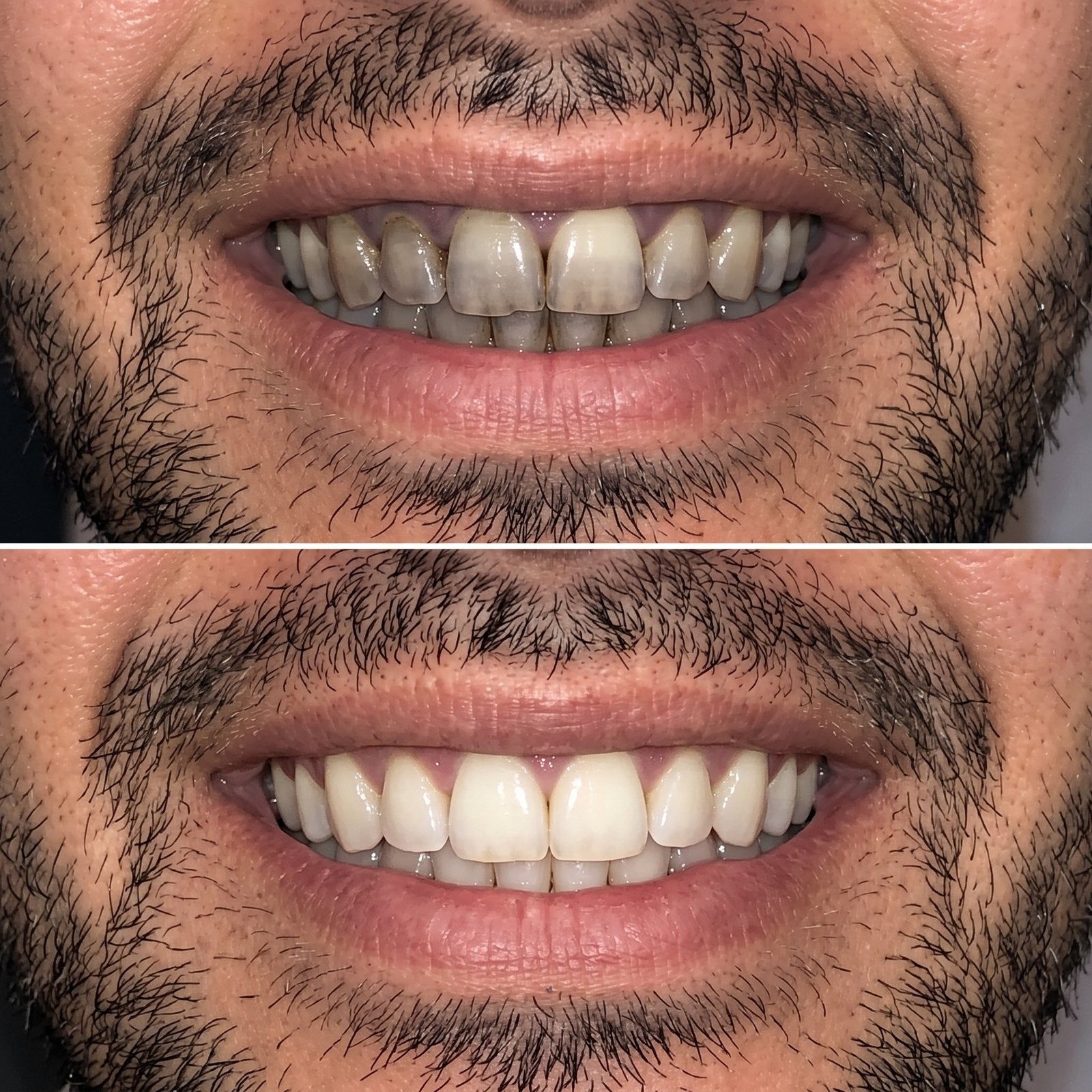 Tobacco staining, before and after surface whitening