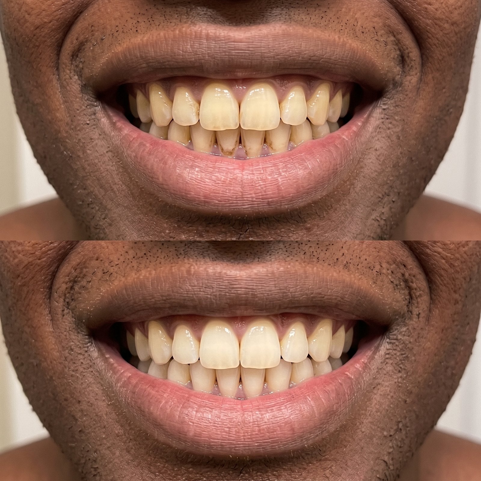Everyday food and drink staining, before and after surface whitening