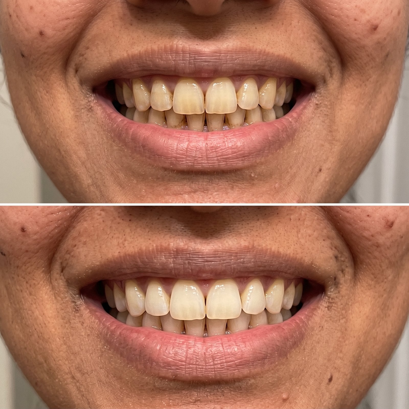 Tea and spice staining, before and after surface whitening